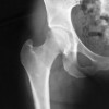 upload/articles/thumbs/031012101033Hip dislocation.jpg